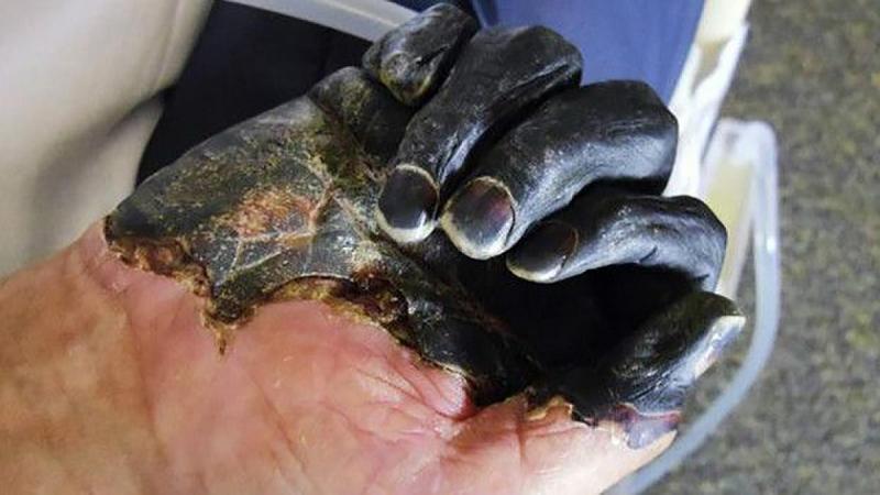 Se desata el pánico en Rusia por un caso de peste negra